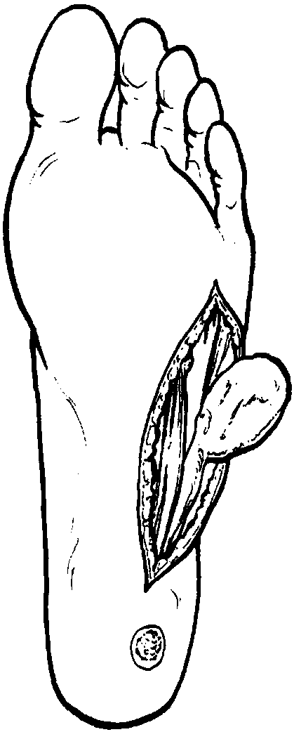 16 跖底外側(cè)皮瓣